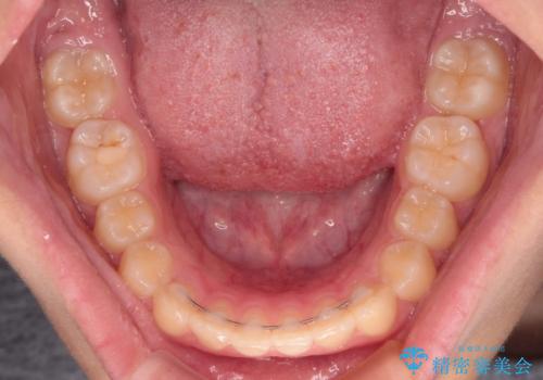 海外で始めたインビザライン 転医手続きにより治療を継続の治療後