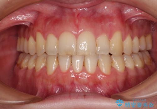 開咬と歯の欠損　ワイヤー装置を併用したインビザライン矯正治療