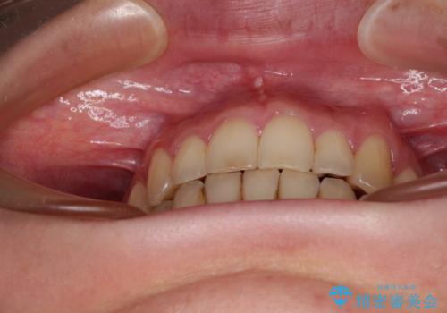 開咬と歯の欠損 ワイヤー装置を併用したインビザライン矯正治療の治療後