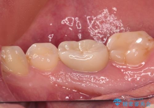 クラウンが外れたままの奥歯 オールセラミッククラウン補綴治療の治療後