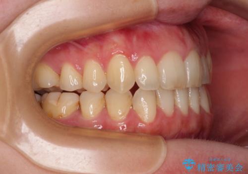 開咬と歯の欠損 ワイヤー装置を併用したインビザライン矯正治療の治療後