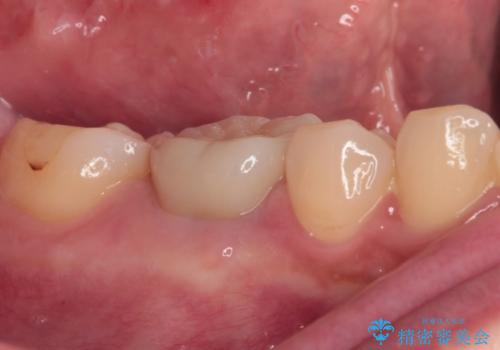 クラウンが外れたままの奥歯 オールセラミッククラウン補綴治療の治療後