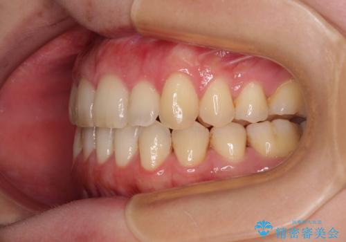 開咬と歯の欠損　ワイヤー装置を併用したインビザライン矯正治療の治療後