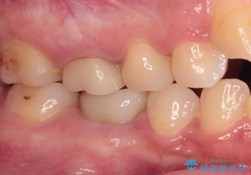 クラウンが外れたままの奥歯 オールセラミッククラウン補綴治療の治療後