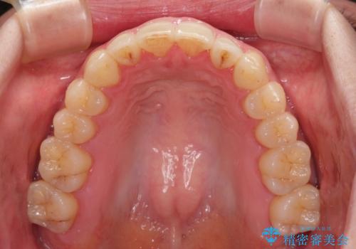 開咬と歯の欠損 ワイヤー装置を併用したインビザライン矯正治療の治療後