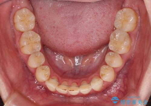 開咬と歯の欠損　ワイヤー装置を併用したインビザライン矯正治療の治療後