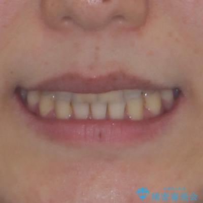 開咬と歯の欠損　ワイヤー装置を併用したインビザライン矯正治療の治療後（顔貌）