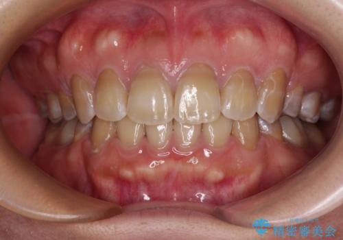 横顔の印象が大きく変わる　ワイヤー装置での抜歯矯正の症例 治療後