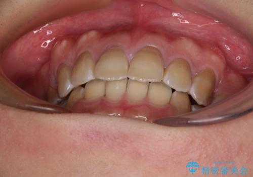 横顔の印象が大きく変わる ワイヤー装置での抜歯矯正の治療後