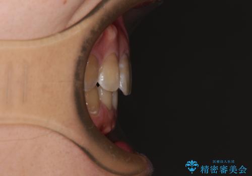 横顔の印象が大きく変わる ワイヤー装置での抜歯矯正の治療後