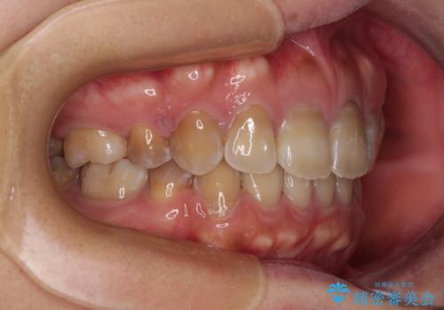 横顔の印象が大きく変わる ワイヤー装置での抜歯矯正の治療後