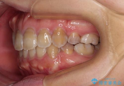 横顔の印象が大きく変わる ワイヤー装置での抜歯矯正の治療後