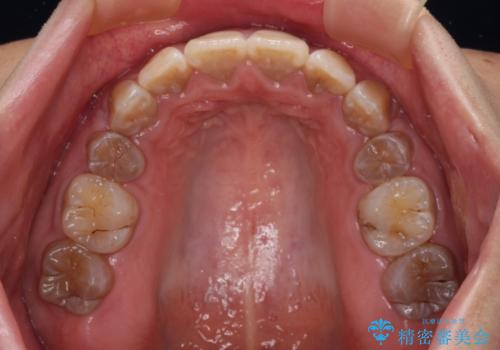 横顔の印象が大きく変わる ワイヤー装置での抜歯矯正の治療後