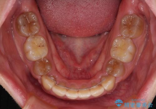 横顔の印象が大きく変わる　ワイヤー装置での抜歯矯正の治療後