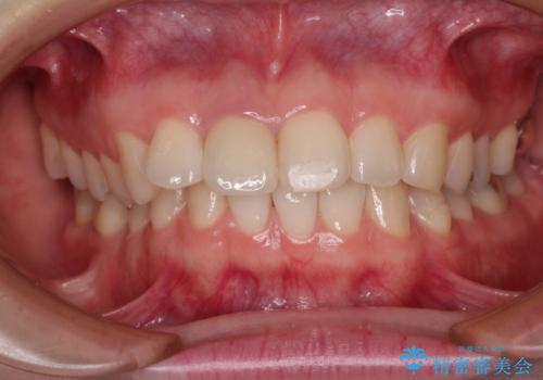 事故でぶつけてから変色した前歯 オールセラミッククラウン補綴治療の治療後