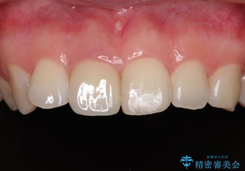事故でぶつけてから変色した前歯 オールセラミッククラウン補綴治療の症例 治療後