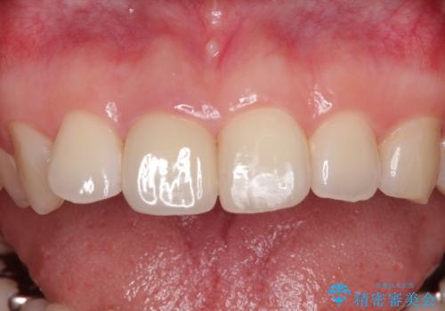 事故でぶつけてから変色した前歯 オールセラミッククラウン補綴治療の治療後