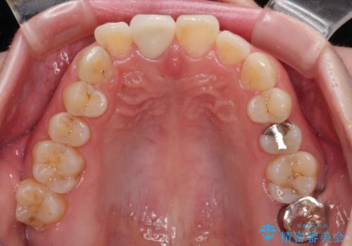 事故でぶつけてから変色した前歯 オールセラミッククラウン補綴治療の治療後