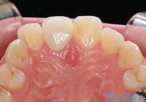 事故でぶつけてから変色した前歯 オールセラミッククラウン補綴治療の治療後