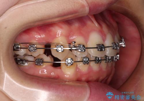 ワイヤー装置の抜歯矯正で横顔のシルエットをすっきりとの治療中