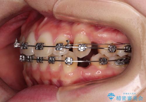 ワイヤー装置の抜歯矯正で横顔のシルエットをすっきりとの治療中