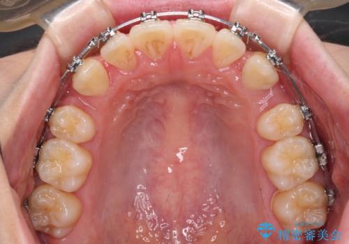 ワイヤー装置の抜歯矯正で横顔のシルエットをすっきりとの治療中