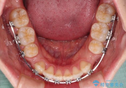 ワイヤー装置の抜歯矯正で横顔のシルエットをすっきりとの治療中