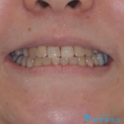 むし歯と咬み合わせで奥歯に負担がかかる　総合歯科治療で悩みを改善の治療後（顔貌）