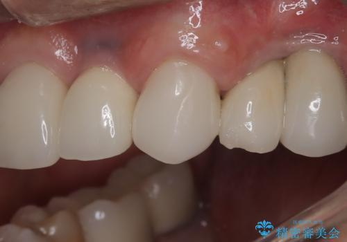 【オールセラミッククラウン・ファイバーコア】被せ物が揺れているの症例 治療後