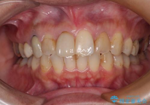 【モニター】処置歯の多い歯列　インビザラインでデコボコを整えるの症例 治療後