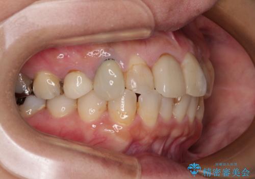 【モニター】処置歯の多い歯列　インビザラインでデコボコを整えるの治療後