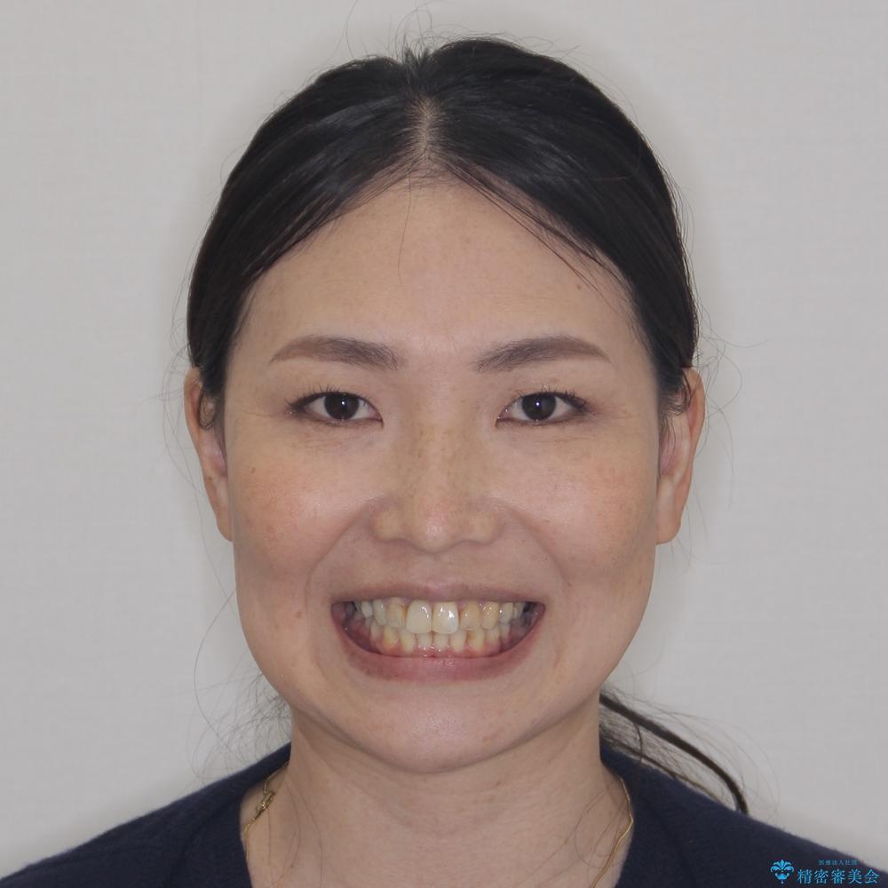 【モニター】処置歯の多い歯列　インビザラインでデコボコを整えるの治療後（顔貌）