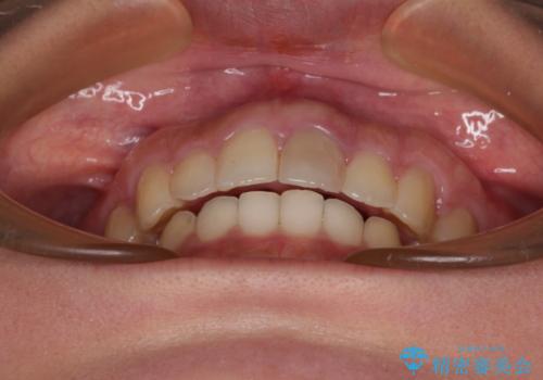 飛び出した上顎前歯 インビザラインで引っ込めるの治療後