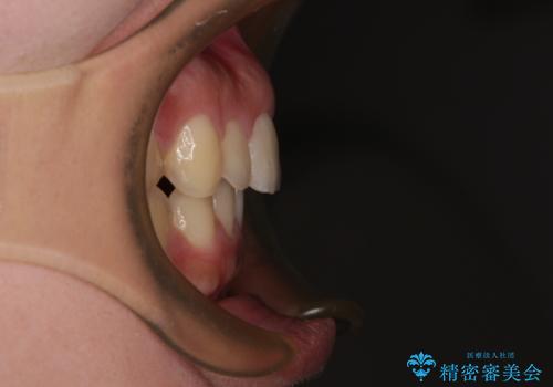 飛び出した上顎前歯 インビザラインで引っ込めるの治療後