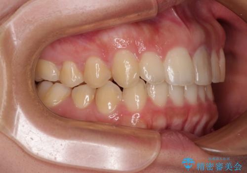 飛び出した上顎前歯 インビザラインで引っ込めるの治療後