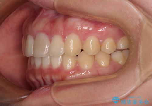 飛び出した上顎前歯 インビザラインで引っ込めるの治療後