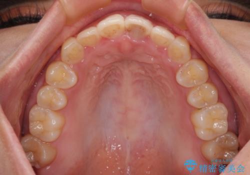 飛び出した上顎前歯 インビザラインで引っ込めるの治療後