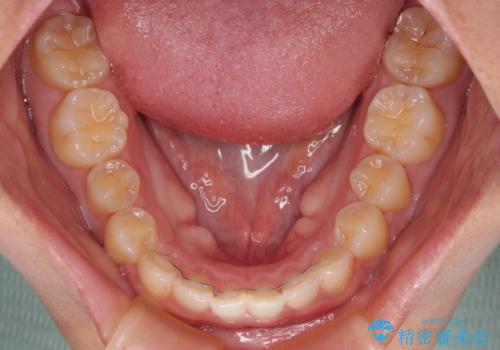 飛び出した上顎前歯 インビザラインで引っ込めるの治療後