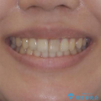 飛び出した上顎前歯 インビザラインで引っ込めるの治療後(顔貌)