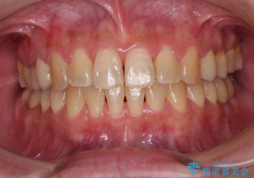 むし歯と咬み合わせで奥歯に負担がかかる　総合歯科治療で悩みを改善の治療後