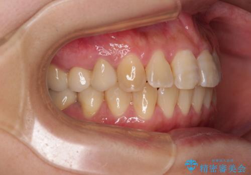 むし歯と咬み合わせで奥歯に負担がかかる　総合歯科治療で悩みを改善の治療後