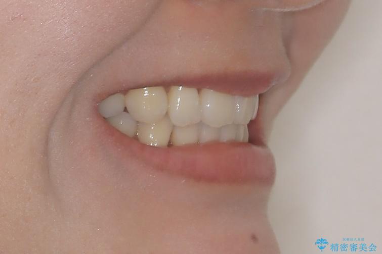 裏側矯正でEラインを改善! すっきりした口元に!の治療後(顔貌)