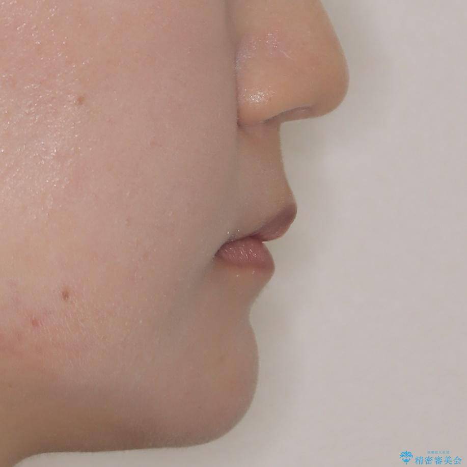 裏側矯正でEラインを改善! すっきりした口元に!の治療後(顔貌)