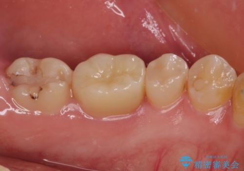 度重なる処置でつぎはぎだらけ オールセラミッククラウンによる補綴治療の治療後