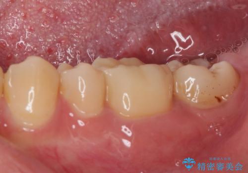 度重なる処置でつぎはぎだらけ オールセラミッククラウンによる補綴治療の治療後