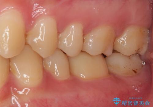 度重なる処置でつぎはぎだらけ オールセラミッククラウンによる補綴治療の治療後