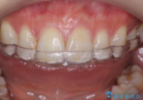 ナイトガードで歯ぎしり予防の治療後