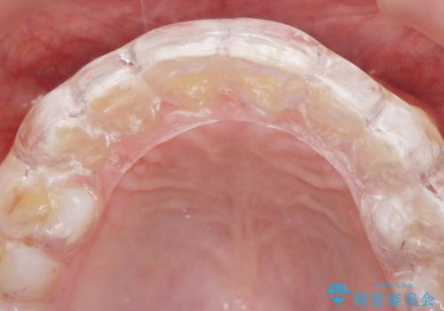 ナイトガードで歯ぎしり予防の治療後