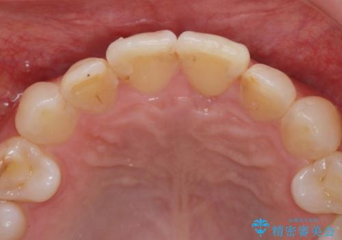ナイトガードで歯ぎしり予防の治療前
