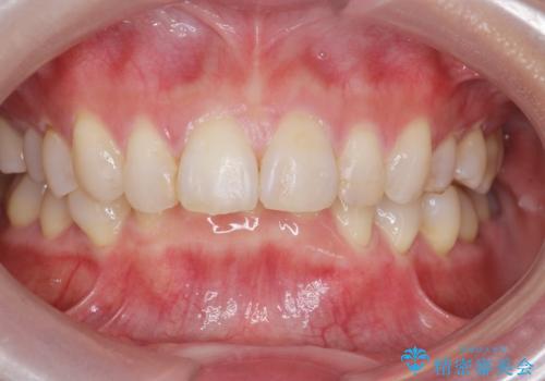 ナイトガードで歯ぎしり予防の症例 治療前